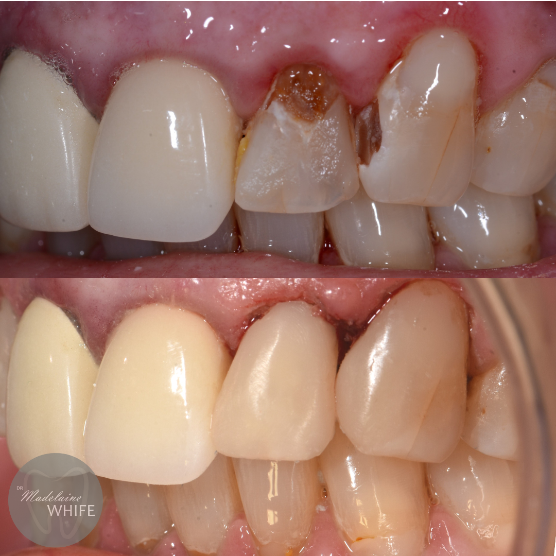 Patient 5 transformation